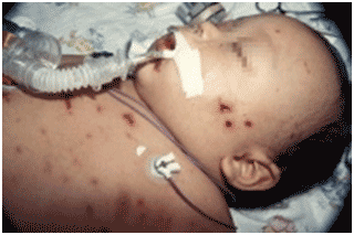 A 9-month-old baby in septic shock with purpuric ...