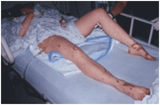 The legs of a 22-year-old woman in septic shock w...