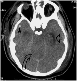 Head CT demonstrates enlargement of the temporal ...