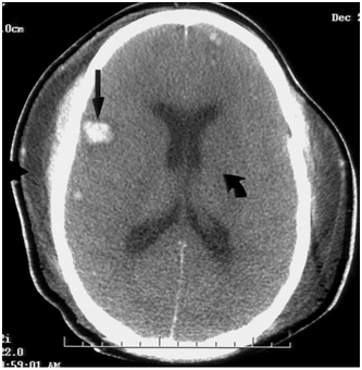 Head CT shows small intracerebral hemorrhage foci...