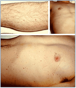 Purpuric lesions in a young adult with fulminant ...
