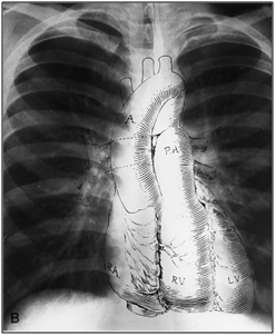 Зүрх ба том судасны рентген шинжилгээ